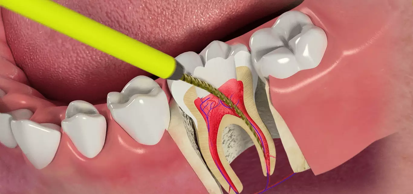 Endodonti